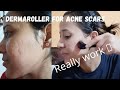 .5mm dermaroller for acne scars|dermaroller use kaise kare|dermaroller before after result