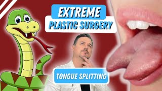 Forked Tongue Surgery by Matthew Schulman MD 7,260 views 1 year ago 2 minutes, 36 seconds