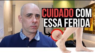 Pernas e úlceras nas meias compressão de