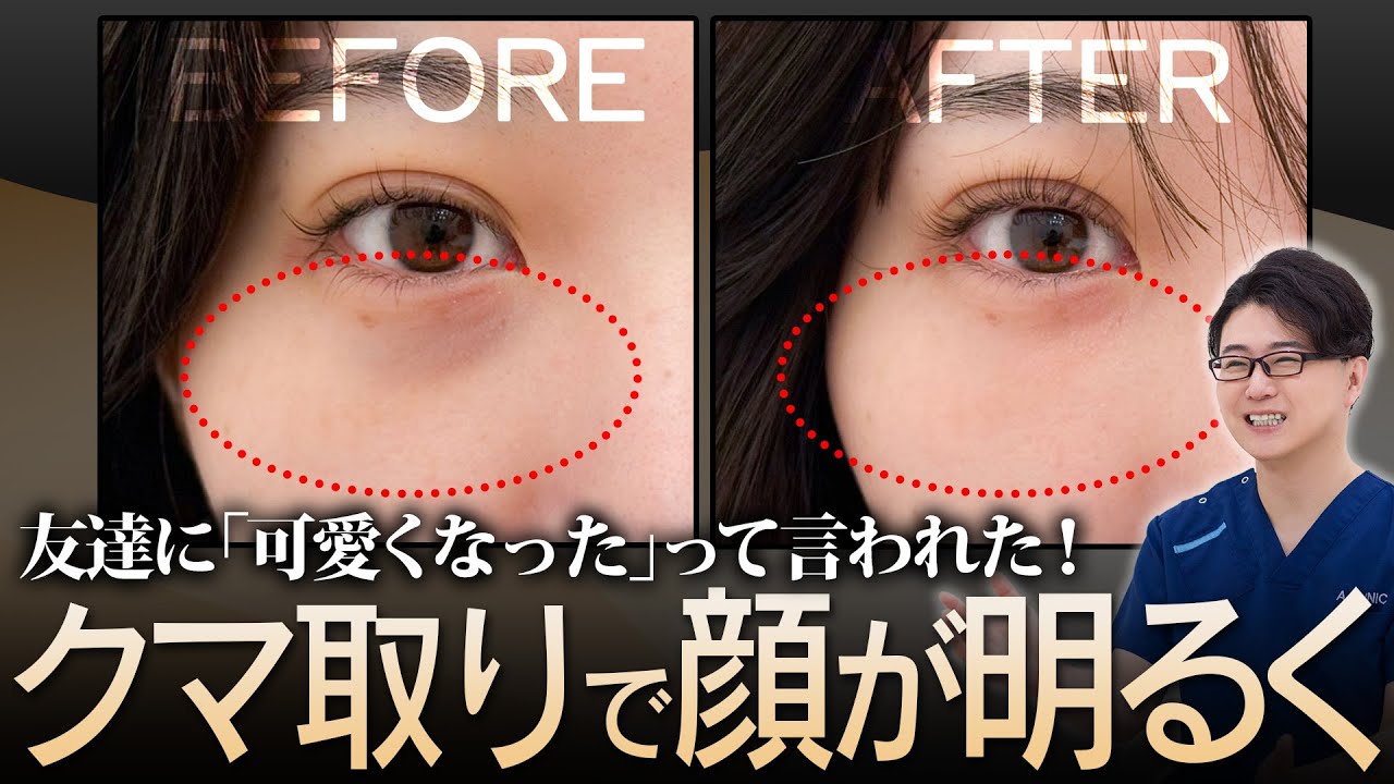 【目の下のクマ取り】TikTokで話題のクマ取りで「涙袋」が出現!? 友達に可愛くなったと褒められたリアルな経過