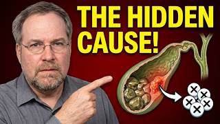 700,000 People Lose Their Gallbladder Every Year — The Real Cause Nobody Is Talking About The Big Gallbladder Mistake That Leads To Surgery 700 000 A Year