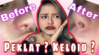 Dermatix Ultra Review - How to remove surgery scars - Keloid removal - Pano mawala ang peklat