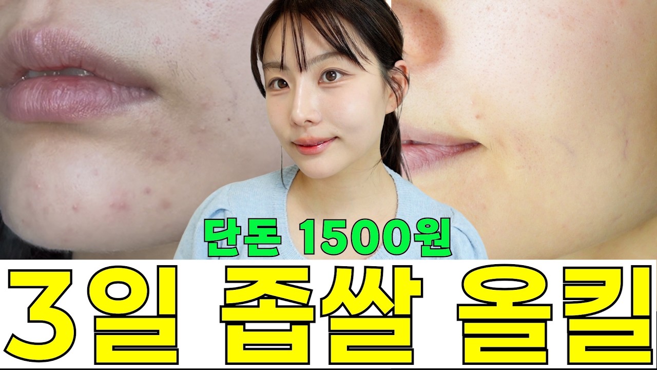 좁쌀여드름, 피부과 가기 전 이 팩부터 하세요!!🔥