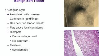 Benign Soft Tissue Tumors - ABOS Orthopedic Surgery Board Exam Review