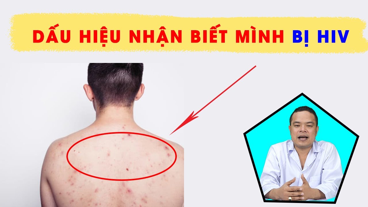 Dấu hiệu bị HIV, AIDS - Bệnh HIV có hiểu hiện và có triệu chứng gì ...