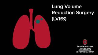 What is lung volume reduction surgery? | Ohio State Medical Center