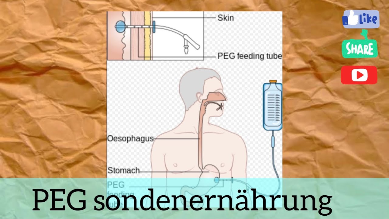 Hören B1B2 Pflege: PEG Sondenernährung - YouTube