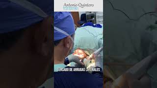 Radiofrecuencia Fraccionado Intensif con Microagujas para rejuvener la piel