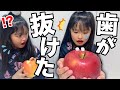 リンゴまるかじり対決してたら前歯が抜けちゃった！！！【ドッキリ】