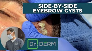 Side-By-Side Eyebrow Cysts | Dr. Derm