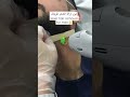      ليزر إزالة الشعر للرجال