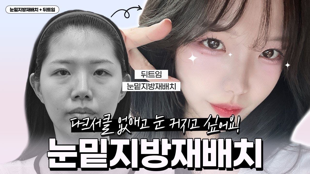 [VLOG] 👁‍🗨눈밑 다크서클 없애고 트임한 후기! 💖 눈밑지방재배치 + 뒤트임