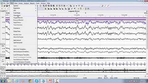 25. RemLogic Hypnogram