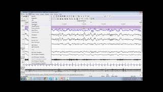 25. RemLogic Hypnogram