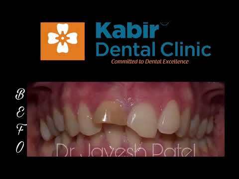 Kabir dental clinic-Dental crown-zirconia,PFM,lithium Disilicate,PFZ,metal