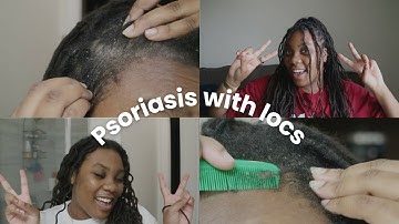 How I Maintain Scalp Psoriasis with Locs | DON