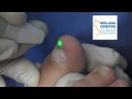 Tratamientos láser para los hongos en las uñas por su Podólogo en Málaga