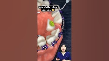 Kéo chiếc răng cửa mọc lệch nhờ niềng răng | Dr Anh Thư