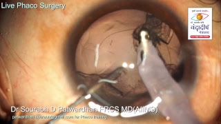 Steroid induced cataract in a 10 year child Sourabh Patwardhan PhacoTips Live Stream