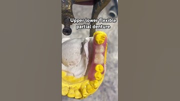 Upper lower flexible partial denture 🤣🤣🤣#splittooth #dentist #apexdental #partialdenture