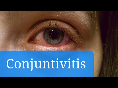 Conjuntivitis vírica, alérgica