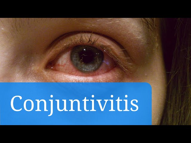¿Pueden las alergias causar una infección ocular?