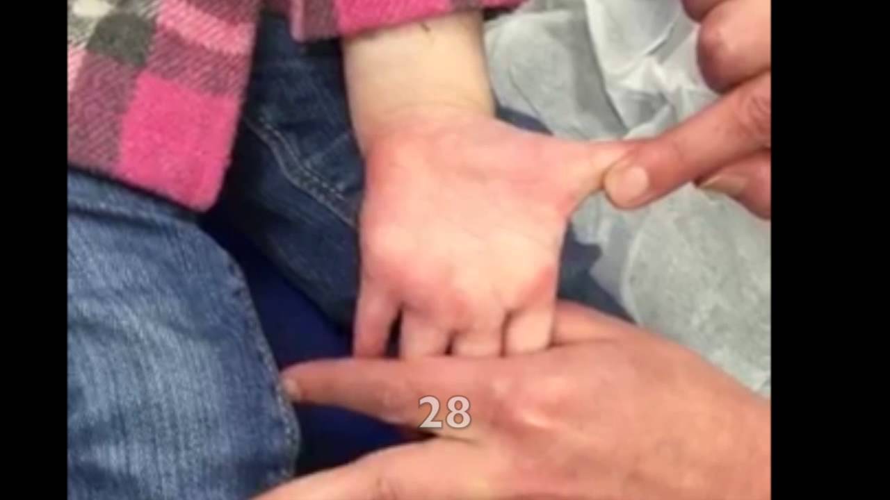 Burns 301: Pediatric Palm Stretch