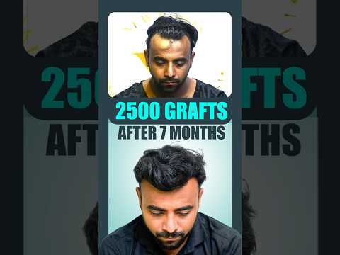 Receding Hairline Restored | 2500 Grafts Sapphire Hair Transplant | 7 Months Amazing Results