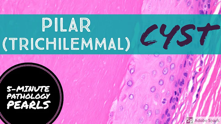 Pilar (Trichilemmal) Cyst 101: 5-Minute Pathology ...