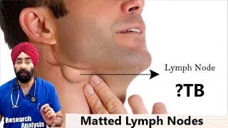 Matted Lymph Nodes क य ह त ह Lymphadenopathy Tb Dr Education Hindi Youtube