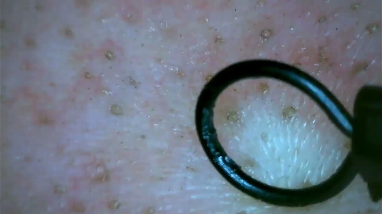 scraping blackheads YouTube