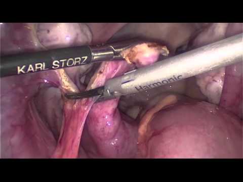 Laparoscopic Fallopian Tube Removal