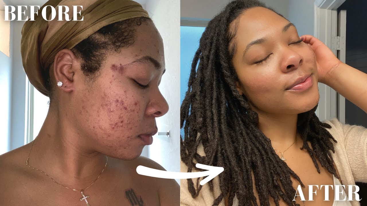 THE BEST SKIN CARE FOR ACNE & HYPERPIGMENTATION | DETAILED AM & PM ...