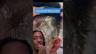 DANDRUFF REMOVAL GONE WRONG! 😱