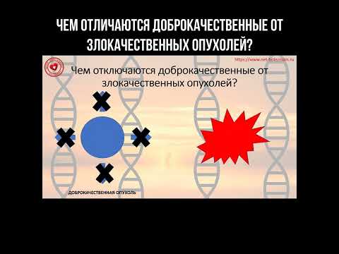 Чем отличаются доброкачественные опухоли от злокачественных? #опухоли #онколог