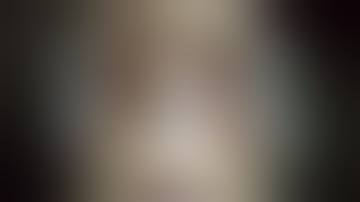 Ipsilateral Expandable Rod in TLIF