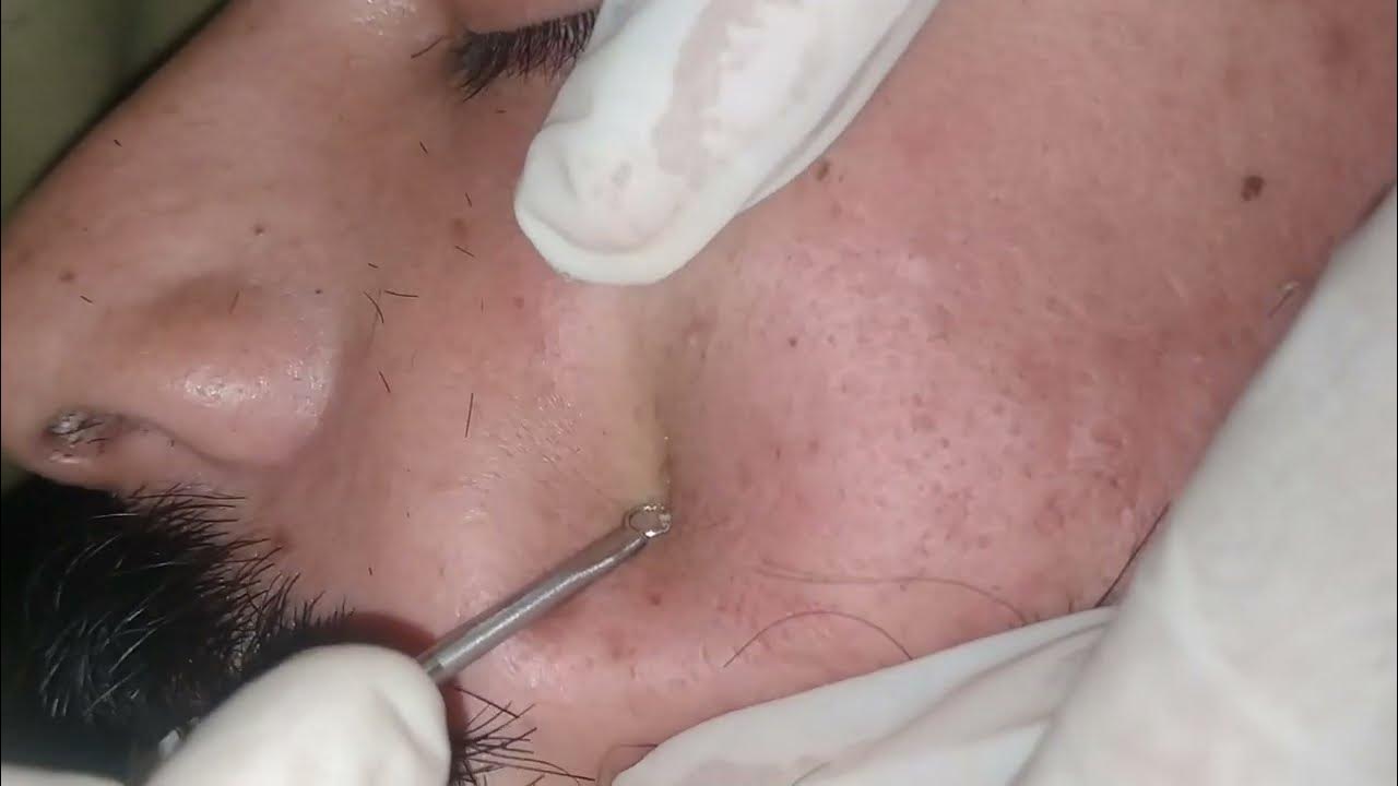 sac dep spa blackheads elderly 2023 blackhead removal relax with sac dep spa 2023 sac dep