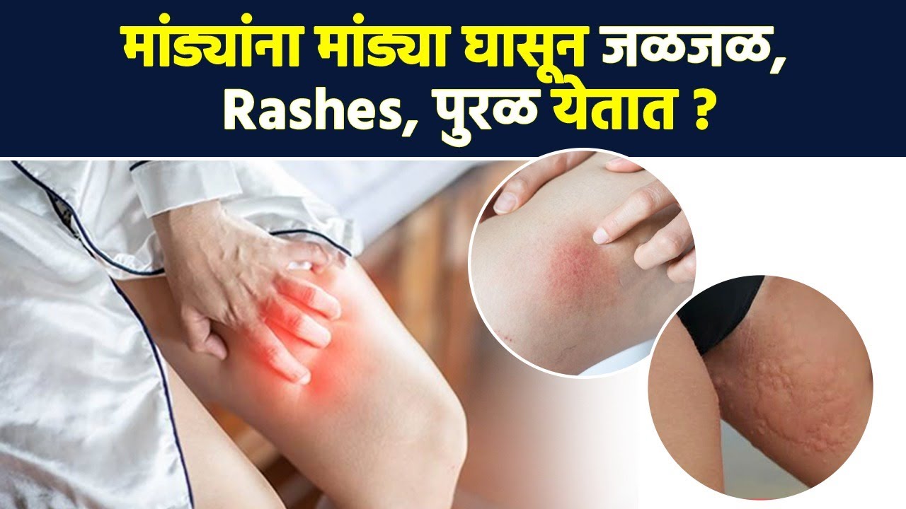 Pakistan Rash 62 मांड्यांना मांड्या घासून त्रास होतो? हा उपाय करा | How to Get Rid of ...