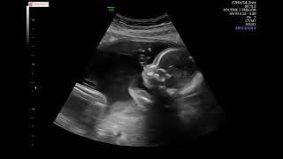 19 weeks Pregnant Ultrasound Anatomy