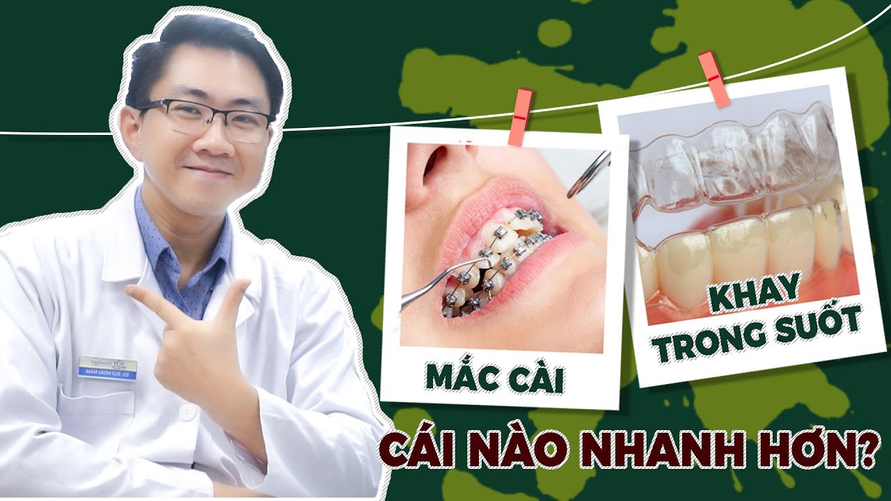 Outline Video Thời Gian Niềng Răng Bằng Khay Trong Suốt Nhanh Hơn Mắc Cài Đúng Hay Sai | Phương Pháp Niềng Răng
