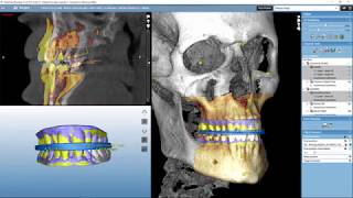 Planmeca Romexis CMF Surgery