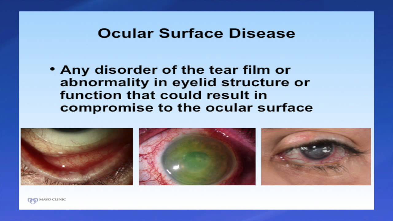 Introduction to Scleral Lenses YouTube