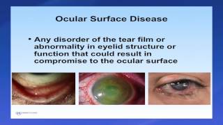 Information Introduction to Scleral Lenses Guide