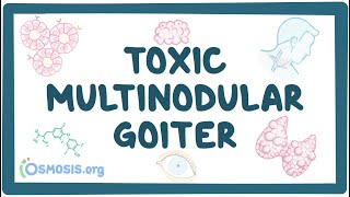 Toxic multinodular goiter  causes, symptoms, diagnosis, treatment, pathology