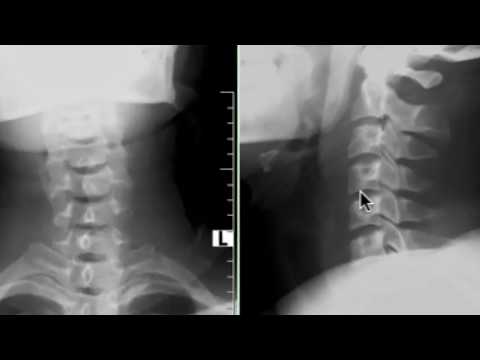 Video: Osteochondrosis 1 Derajat: Lumbar, Toraks, Tulang Belakang Leher