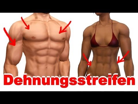 Schwangerschaftsstreifen männer