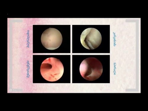 თანამედროვე მიმართულებები საშვილოსნოს ყელის დაავადებათა დიაგნოსტიკასა და მკურნალობაში