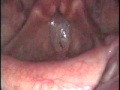 Smokers polyps or Reinke's edema