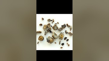 Kidney stones (real images) #renalcalculi #kidneydisease #kidneyhealth