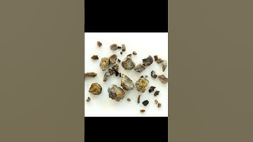Kidney stones (real images) #renalcalculi #kidneydisease #kidneyhealth